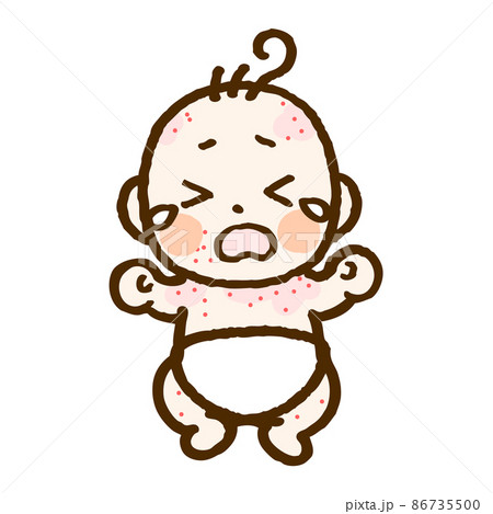 アトピーの赤ちゃん(フルカラー) アトピーの赤ちゃん(フルカラー) 86735500
