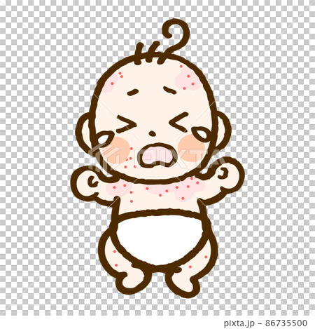 アトピーの赤ちゃん(フルカラー) アトピーの赤ちゃん(フルカラー) 86735500