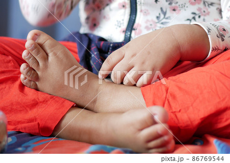 child girl suffering from itching skin, close up. child girl suffering from itching skin, close up. 86769544