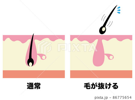 毛穴(通常・毛が抜ける) 毛穴(通常・毛が抜ける) 86775654