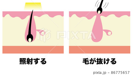 毛穴 照射する 毛が抜ける のイラスト素材