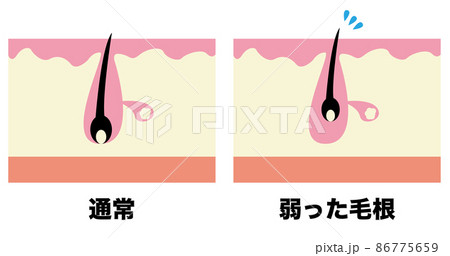 毛穴(通常・弱った毛根) 86775659