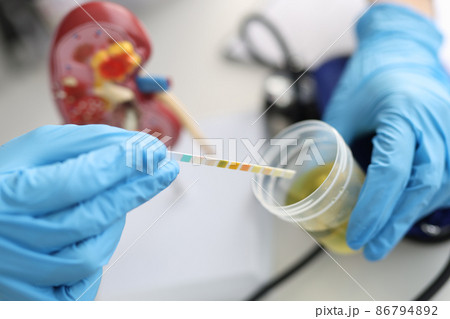 Doctor urologist making express urine test using indicator paper closeup 86794892