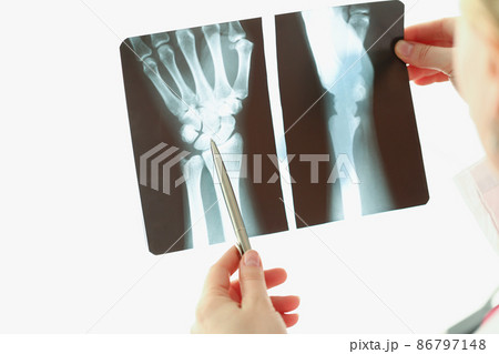 Medical worker examine patient hand x ray result on light 86797148