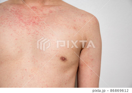 Dermatitis rash viral disease with immunodeficiency on body of young adult asian, scratch with itch 86869612