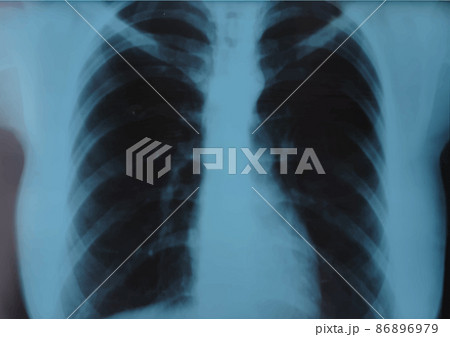 Rib MRI, X ray of thoracic spine, thorax x ray check up, fluorography image. Realistic Vector illustration 86896979