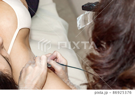 The process of permanent removal of unwanted hair in the armpit area using an electroepilation device and tweezers. The process of permanent removal of unwanted hair in the armpit area using an electroepilation device and tweezers. 86925376