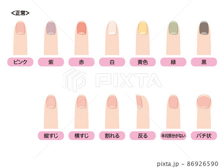 爪で見る健康状態 爪で見る健康状態 86926590