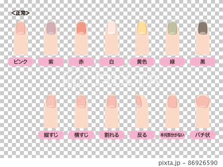 爪で見る健康状態 爪で見る健康状態 86926590