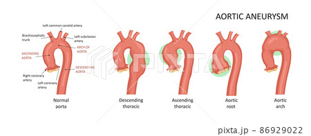 Types of aortic aneurysms: root, ascending, descending,arch. 86929022
