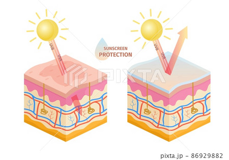 Human skin uv rays protection, before and after sunscreen. Sun uva, uvb epidermis damage prevention lotion. Skin sunburn vector infographic Human skin uv rays protection, before and after sunscreen. Sun uva, uvb epidermis damage prevention lotion. Skin sunburn vector infographic 86929882