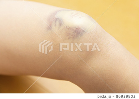 子供の足のキズに貼った絆創膏 86939903