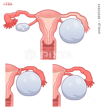 卵巣嚢腫、茎捻転の子宮のイラスト 卵巣嚢腫、茎捻転の子宮のイラスト 86950944