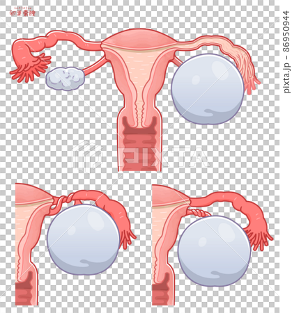 卵巣嚢腫、茎捻転の子宮のイラスト 卵巣嚢腫、茎捻転の子宮のイラスト 86950944