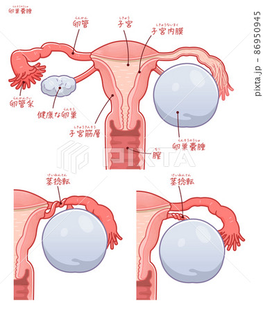 卵巣嚢腫のイラスト テキスト付き のイラスト素材