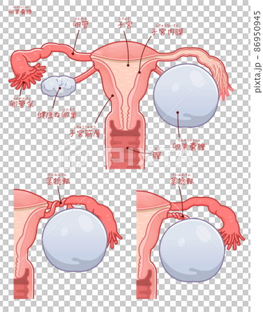 Illustration of uterus with ovarian cyst and pedicle torsion (with text) 86950945