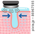 美顔器でお肌のケアをしている時の皮膚細胞断面図（毛穴） 86967593