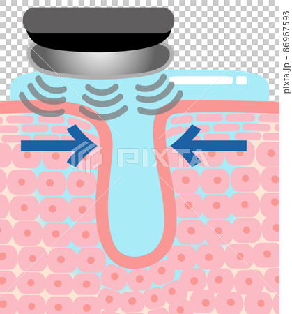 使用面部設備護理皮膚時皮膚細胞（毛孔）的橫截面視圖 86967593