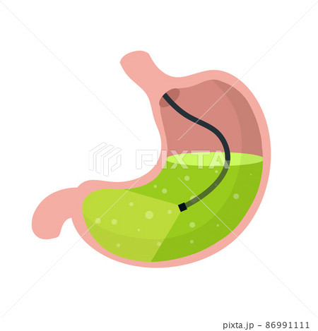 Gastroscopy. Endoscopy and digestive problem 86991111