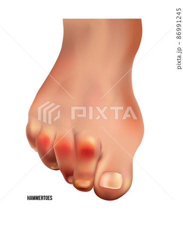 Realistic hammer toes of human leg with red pain points frontal view. Realistic hammer toes of human leg with red pain points frontal view. 86991245