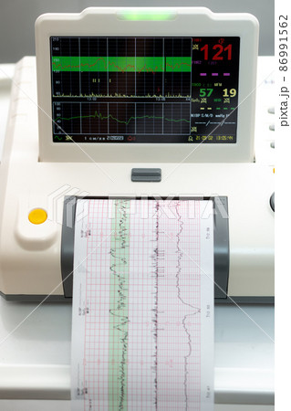 Electronic Cardiotocography Machine Monitoring Fetal Heart Contractions Of Uterus. Printing Cardiogram Report Coming Out Electrocardiogram In Labor Ward During Pregnancy. Medical Diagnostic Equipment 86991562