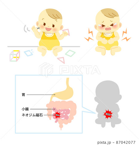 イラスト素材:マグネットパズルの破損で内蔵のネオジム磁石を幼児が誤飲し胃や腸に穴が開く事故 87042077