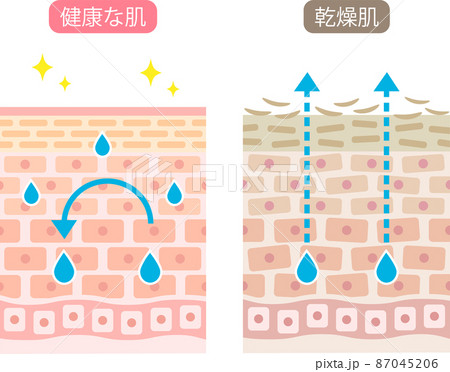 乾燥肌　断面図　ビフォアアフター 87045206
