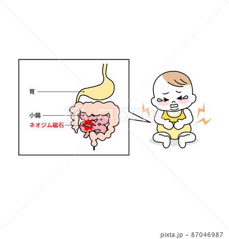 玩具(マグネットパズル)が破損し内蔵されていたネオジム磁石が腸管壁を穿孔する場面の説明図解/主線あり 87046987