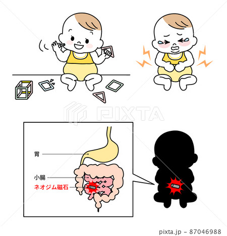 イラスト素材:マグネットパズルの破損で内蔵のネオジム磁石を幼児が誤飲し胃や腸に穴が開く事故/主線あり 87046988