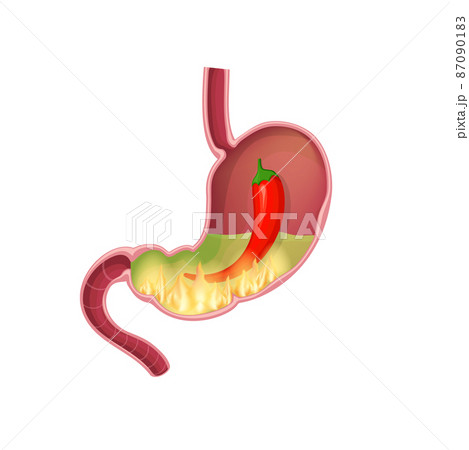 Stomach with red pepper fire, gas and gastric acid 87090183