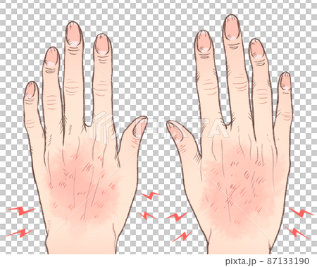 しもやけで荒れた手の甲 87133190