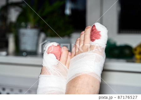 A man's legs with blood bandaged big toes. Window at the background A man's legs with blood bandaged big toes. Window at the background 87176527