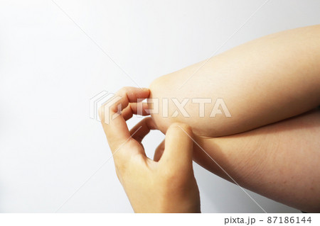 アトピー性皮膚炎 カサカサの皮膚 87186144