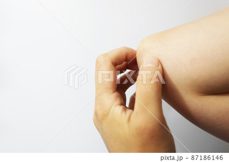 アトピー性皮膚炎 カサカサの皮膚 87186146