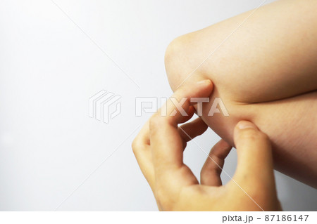 アトピー性皮膚炎 カサカサの皮膚 アトピー性皮膚炎 カサカサの皮膚 87186147