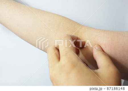 アトピー性皮膚炎 カサカサの皮膚 アトピー性皮膚炎 カサカサの皮膚 87186148