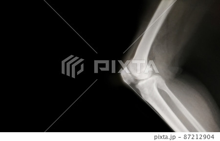 knee bone computer x-ray images 87212904