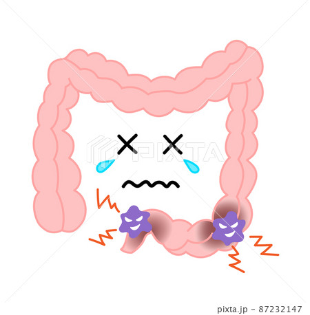 大腸がんのイラスト 87232147
