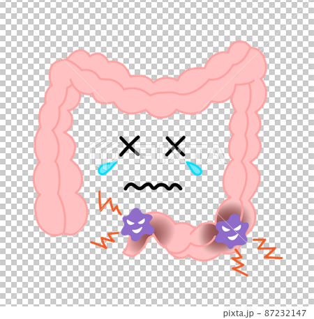 大腸がんのイラスト 87232147