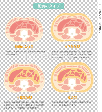 肥満のタイプ 肥満のタイプ 87280007