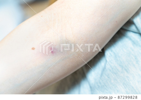 腕にできたアザの写真。家庭内暴力・怪我のイメージ。 腕にできたアザの写真。家庭内暴力・怪我のイメージ。 87299828