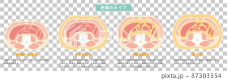 Obesity type 03 87303554