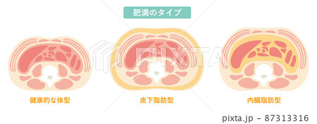 肥満のタイプ08 肥満のタイプ08 87313316