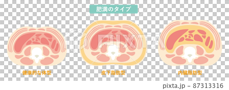 Obesity type 08 87313316