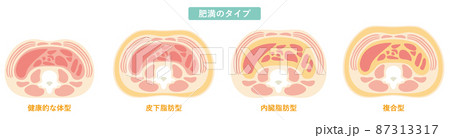 肥満のタイプ07 87313317