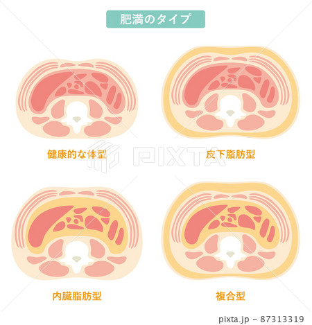 肥満のタイプ05 87313319