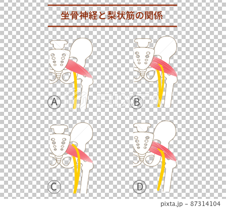 梨狀肌和坐骨神經圖解 87314104