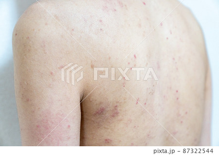 アトピー / あせも / 皮膚炎のイメージ。 肌荒れ男性の写真。 アトピー / あせも / 皮膚炎のイメージ。 肌荒れ男性の写真。 87322544