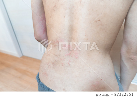 アトピー / あせも / 皮膚炎のイメージ。　肌荒れ男性の写真。 87322551