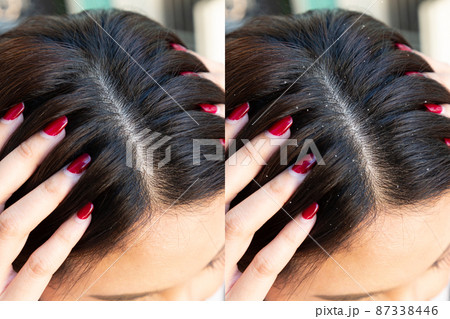 Woman Before and After dandruff Treatment. Problem health care concept. 87338446